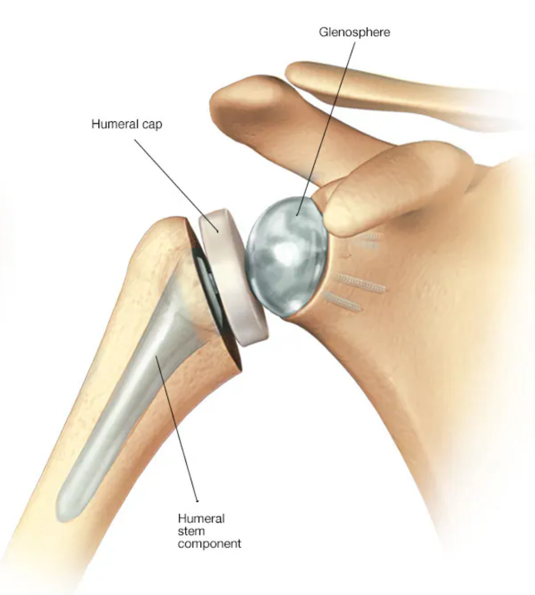 Recovery after shoulder replacement surgery in Delhi