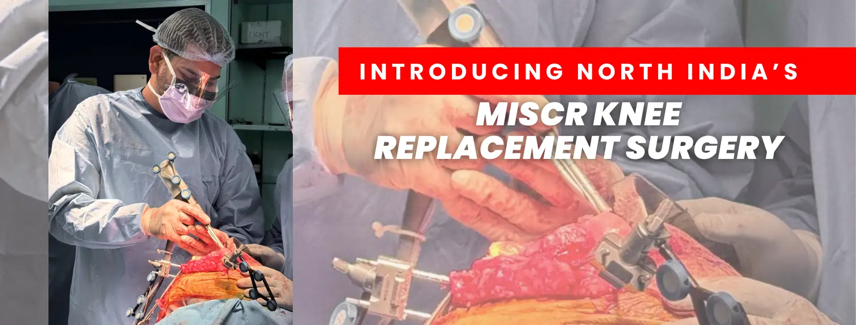 MISCR knee replacement surgery in Delhi by orthopedic doctor