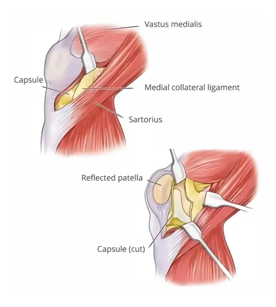 MISCR knee replacement surgery performed by best knee replacement surgeon in Delhi