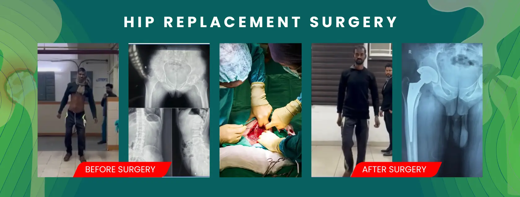 Hip replacement surgery in Delhi by experienced orthopedic surgeon