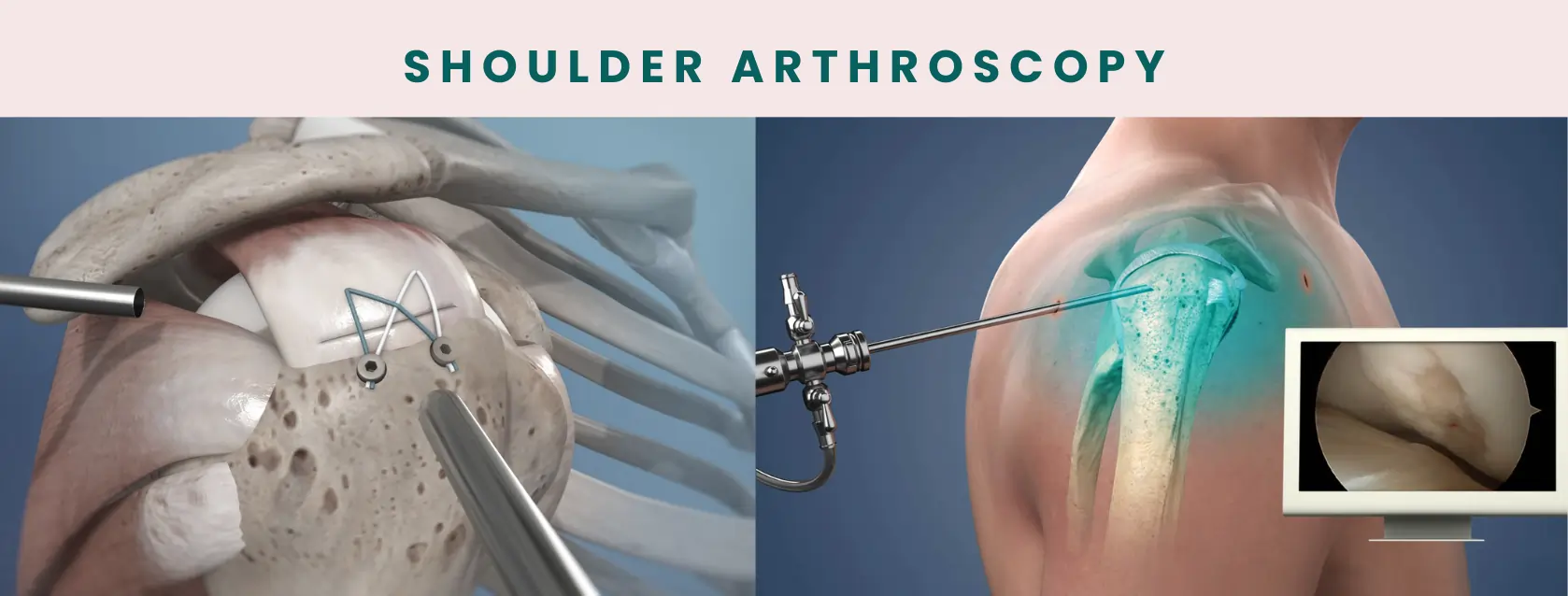 Shoulder arthroscopy treatment in Delhi by orthopedic specialist